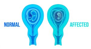 정상 임신과 계류유산의 의학적 상태 비교 다이어그램